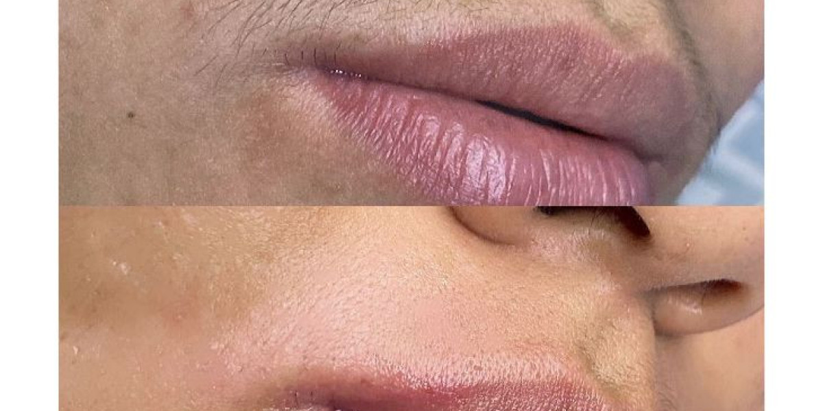 Laser Hair Removal – Effortless Hair Reduction for Smooth Skin