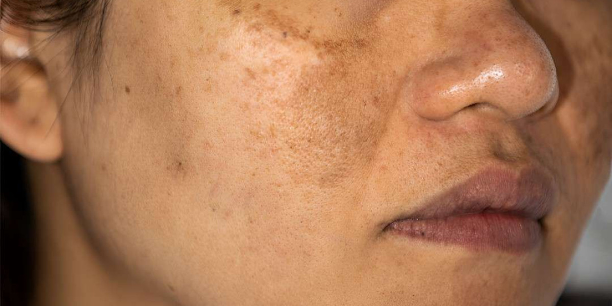 Safe Pigmentation Treatment in Islamabad