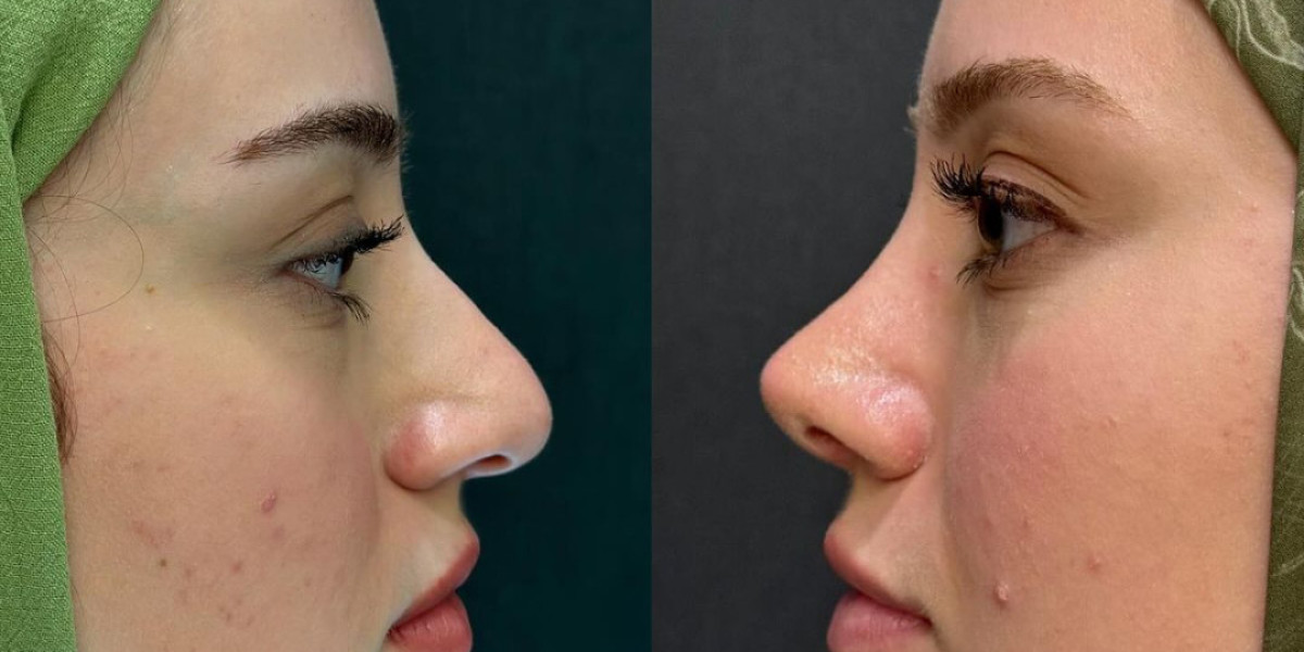 Perfect Your Nose with Rhinoplasty in Islamabad