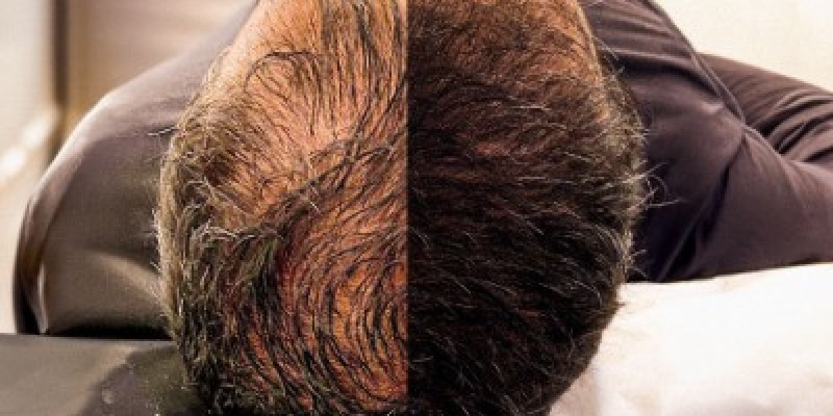 Professional Hair Transplant Services in Islamabad