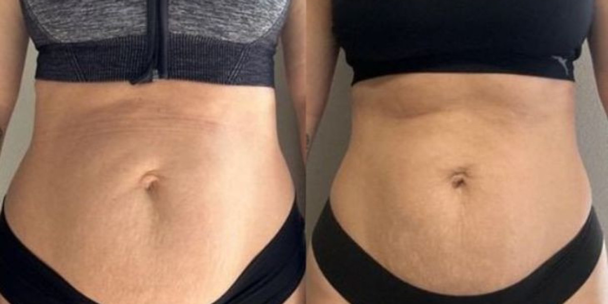 Liposuction in Islamabad – Transforming Body Contours Safely