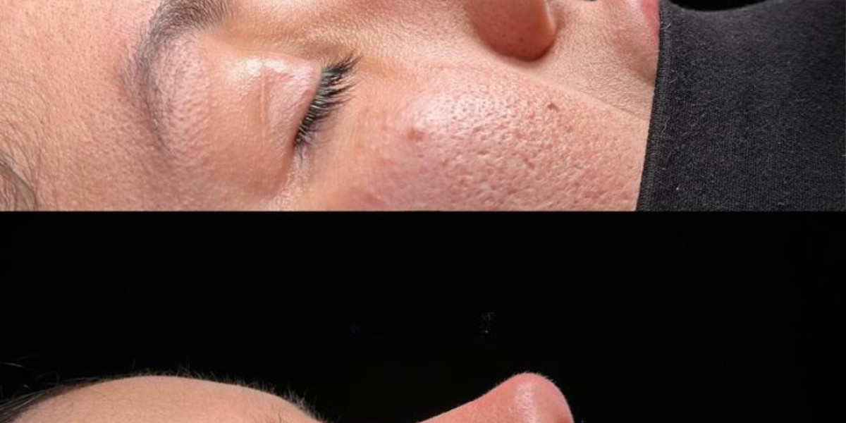 Achieve Facial Harmony with Rhinoplasty in Islamabad