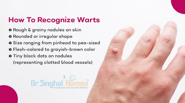 Know Common Warts Symptoms and Causes Today