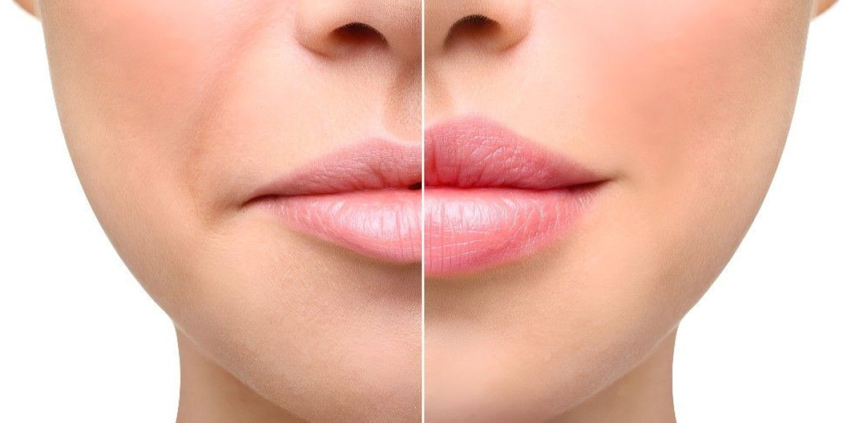 Get the Look: Lip Augmentation in Islamabad