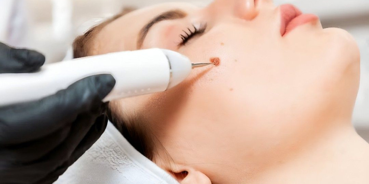 Wart Removal in Islamabad – Safe & Effective Solutions