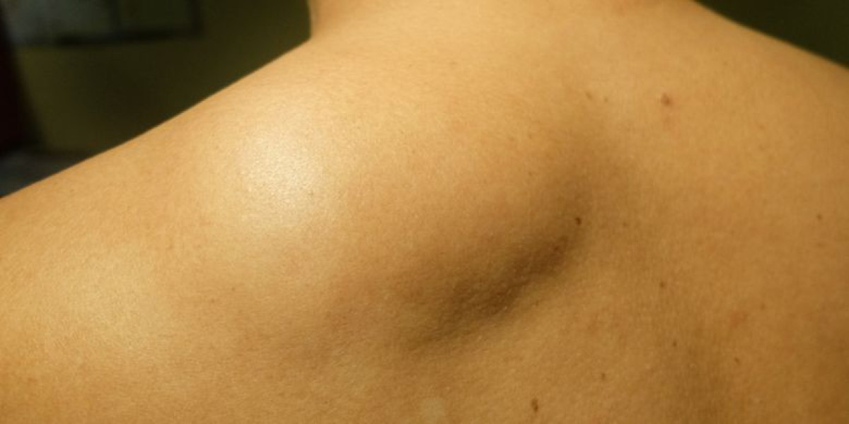 Fast Lipoma Treatment in Islamabad – Say Goodbye to Lumps