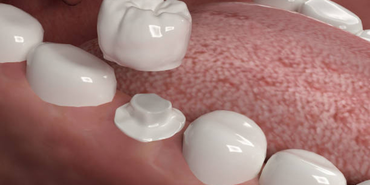 Repair and Strengthen Your Smile with Dental crown in Islamabad