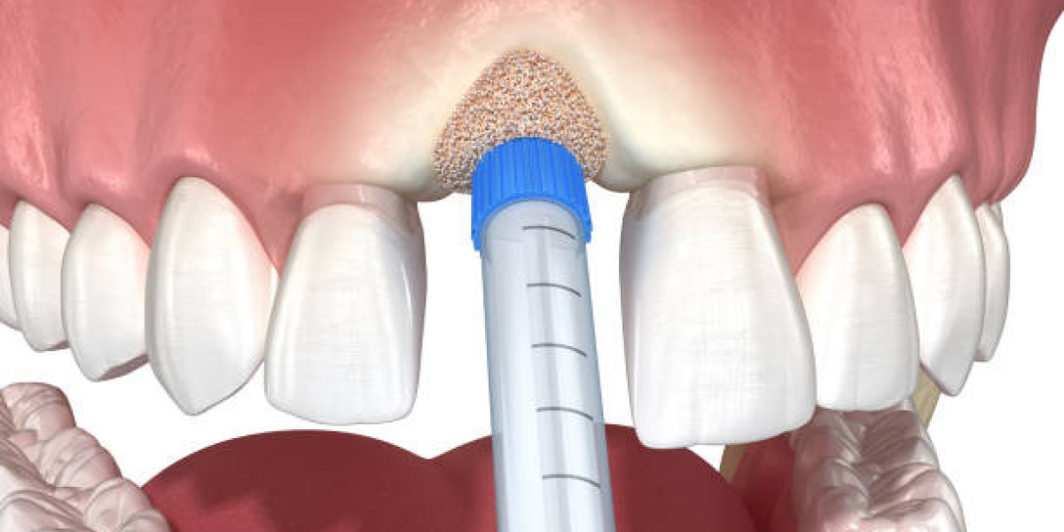 Gum Grafting in Islamabad: Protect Your Gums and Enhance Your Smile