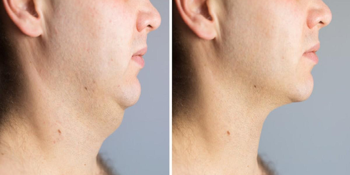 Get a Slimmer Chin with Expert Lipo in Islamabad