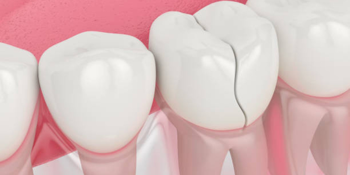 Restore Your Smile: Tooth Fracture Treatment in Islamabad