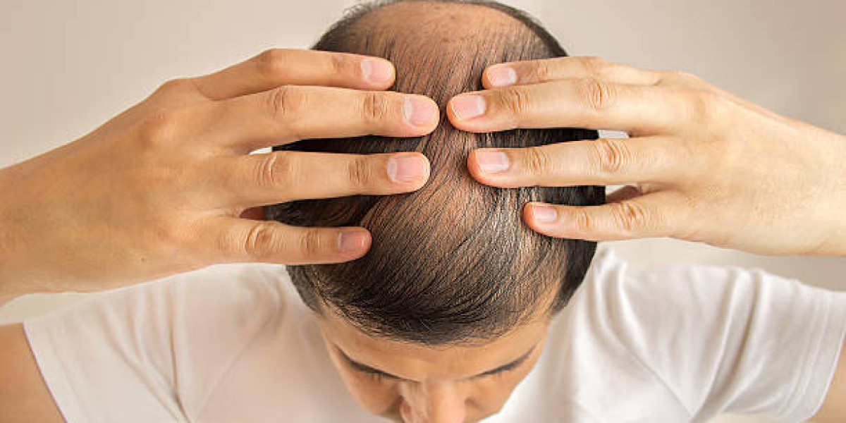 Complete Guide to Hair Loss Treatment in Islamabad