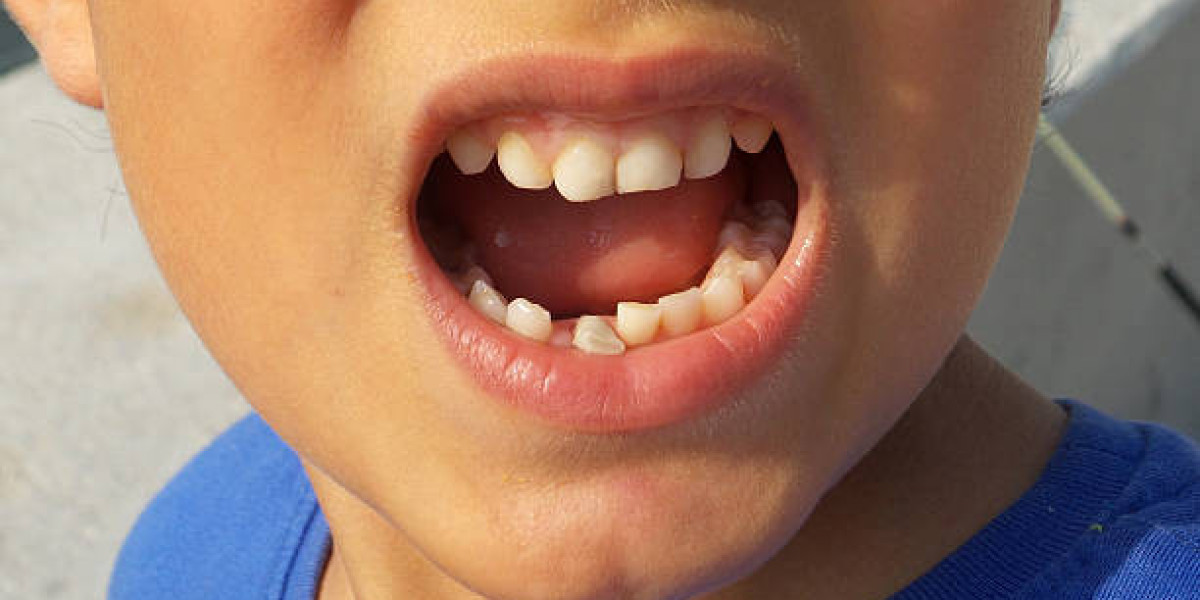 A Complete Patient Guide to Tooth Fracture Treatment in Islamabad
