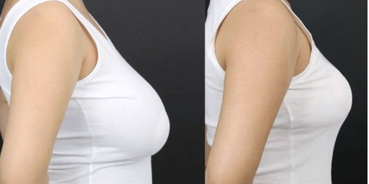 Confidence Restored: Breast Reduction in Islamabad