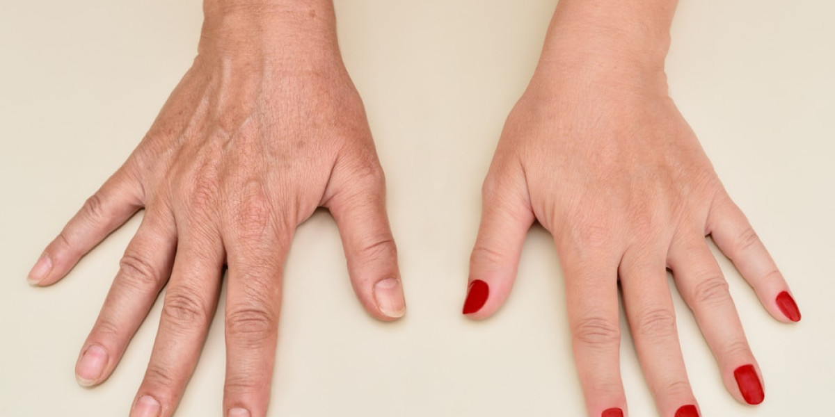 Age-Defying Hands: Advanced Rejuvenation for Lasting Glow