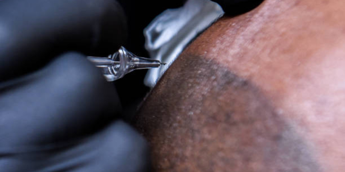 A Trusted Non-Surgical Option: Scalp Micropigmentation Treatment in Islamabad