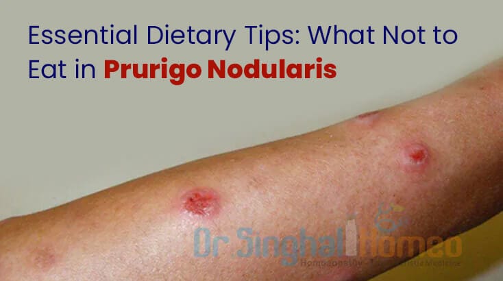 Which Foods to Avoid or Prefer During Prurigo Nodularis?