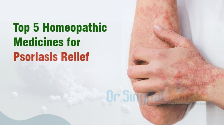 Best Homeopathic Medicines for Psoriasis Relief