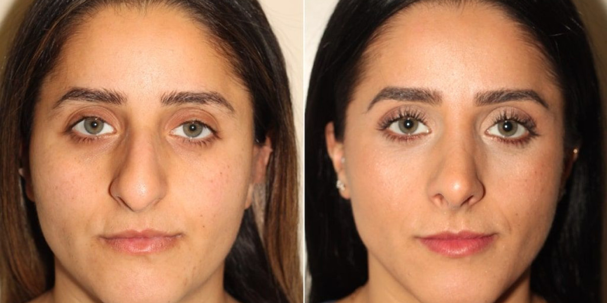 Rhinoplasty in Islamabad: Recovery Timeline, Tips, and Long-Term Car