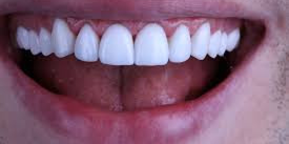 Complete Guide to a Perfect Celebrity-Like Smile Hollywood Smile in Islamabad: