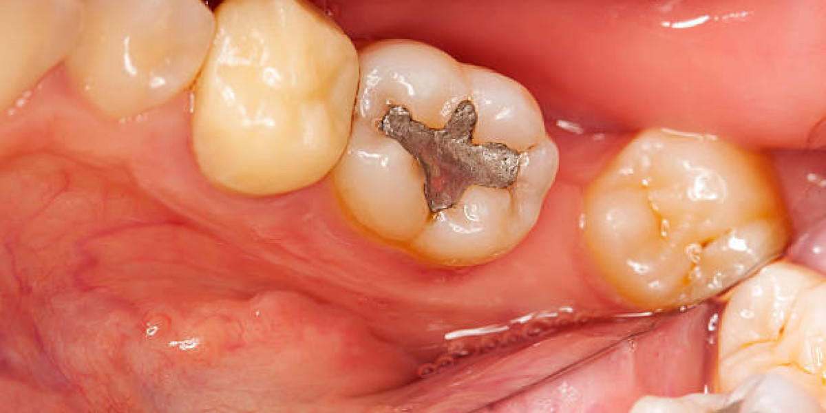 Trusted Dental Fillings in Islamabad for Healthy Teeth