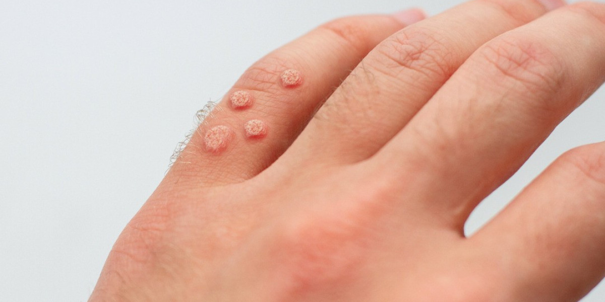 Achieve Smooth Skin with Wart Removal
