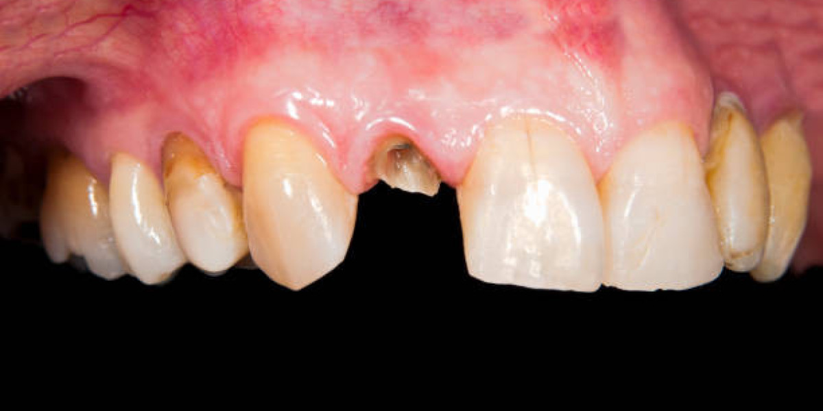 Complications of Untreated Tooth Fractures and Advanced Dental Solutions in Pakistan