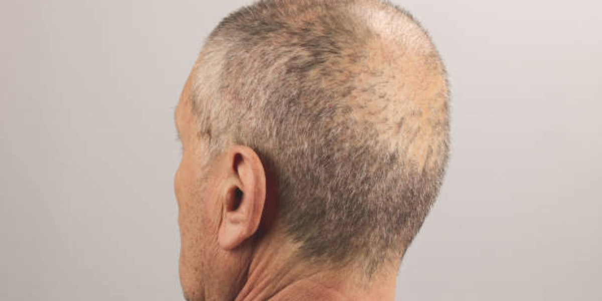 FUE Hair Transplant in Islamabad – Effective Solution for Natural and Permanent Hair Growth