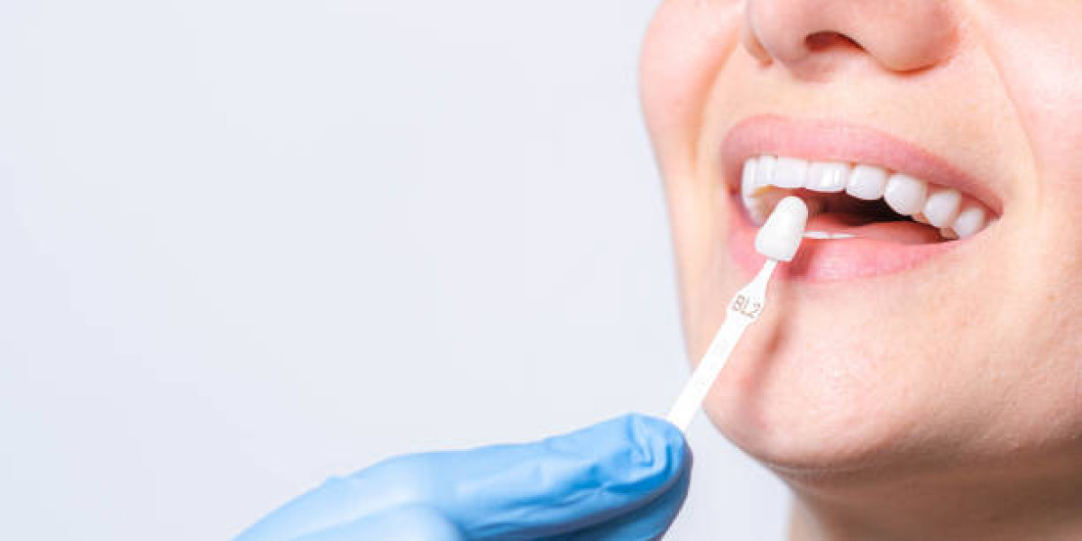 Dental Veneers in Pakistan: Lifestyle Impact, Eating Habits & Daily Life Changes