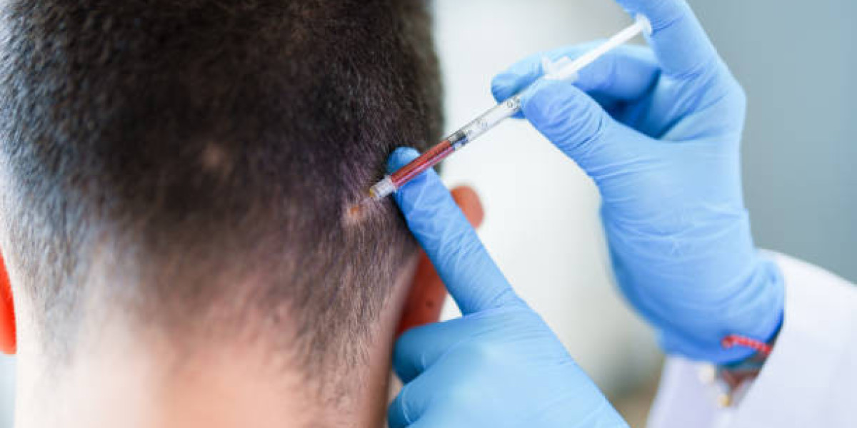 Can It Improve Hair Texture and Quality?PRP Hair Treatment in Islamabad: