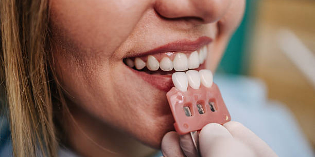 Understanding the Long-Term Benefits of Smile Enhancement Dental Veneers in Islamabad Pakistan: