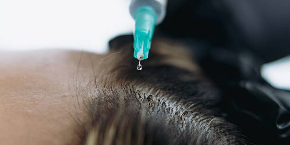 Revolutionizing Hair Restoration with Regenerative Medicine Exosome Hair Therapy in Islamabad: