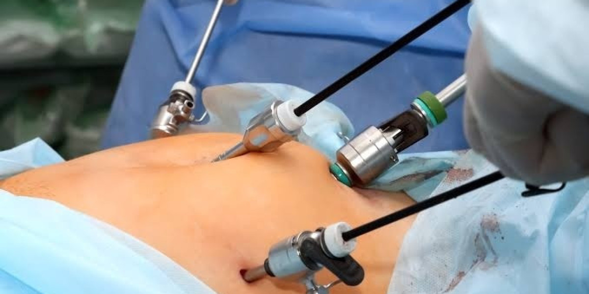 Laparoscopic Surgery for Gallbladder Problems: A Complete Guide